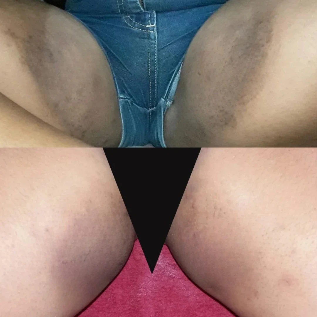 Resultado real: virilha antes (em cima) e depois (embaixo) do tratamento Floríntima