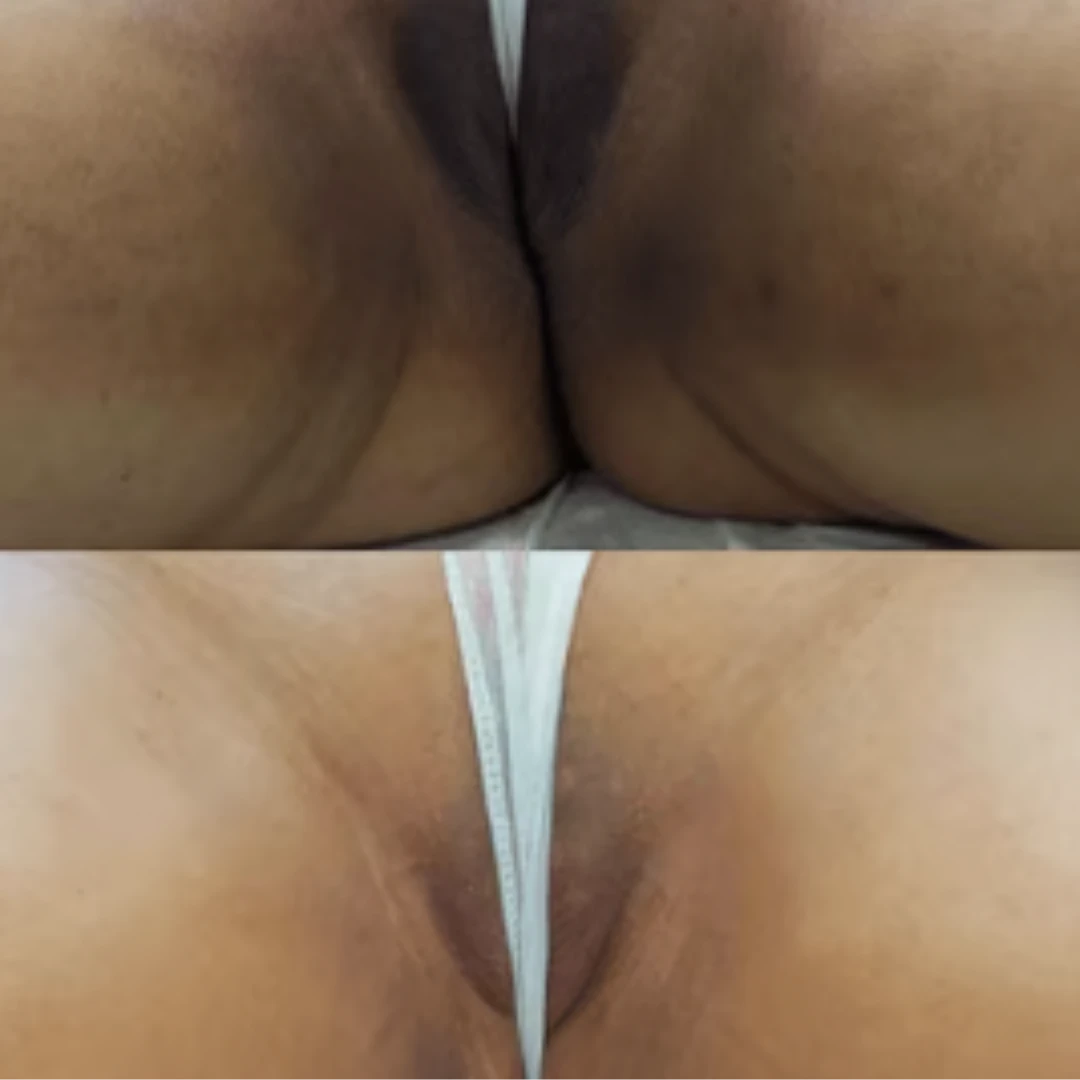 Resultado real: virilha e região íntima antes (em cima) e depois (embaixo) do tratamento Floríntima